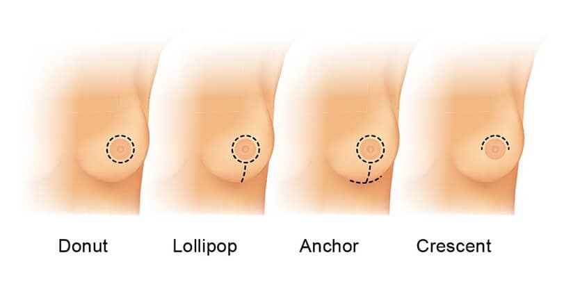 RÃ©sultat de recherche d'images pour "breast reduction"